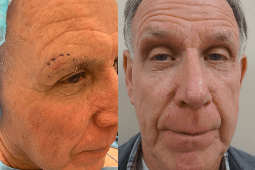 Male Eye Brow Before and After