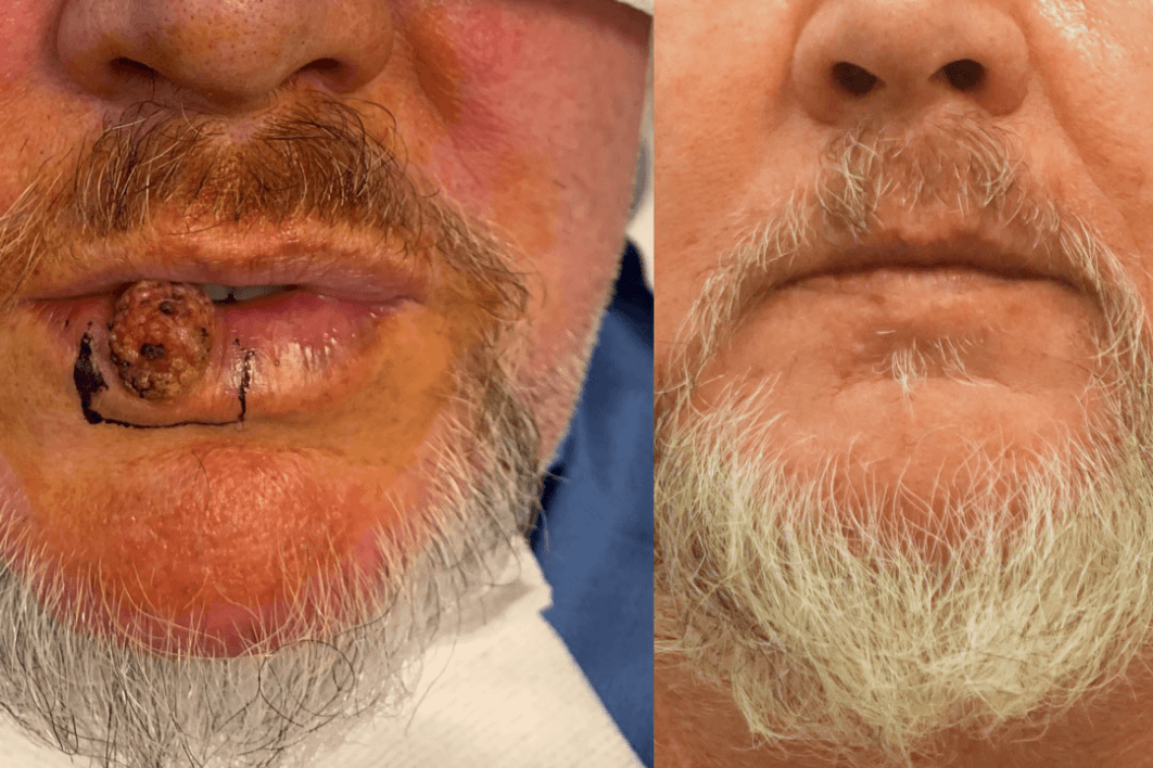 Lip Cancer Reconstruction (Before & After Results)