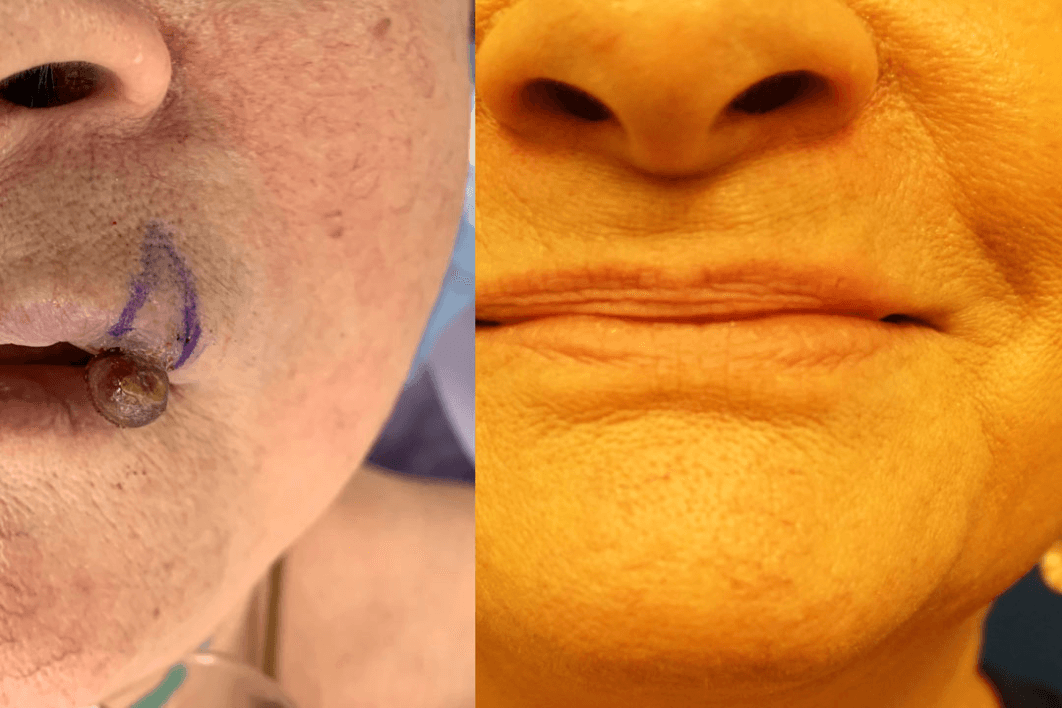 Lip Reconstruction (Before & After Results)