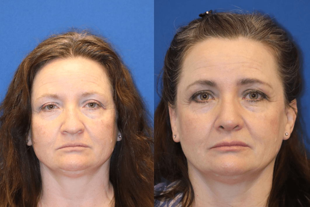 Rhinoplasty Woman - Before & After