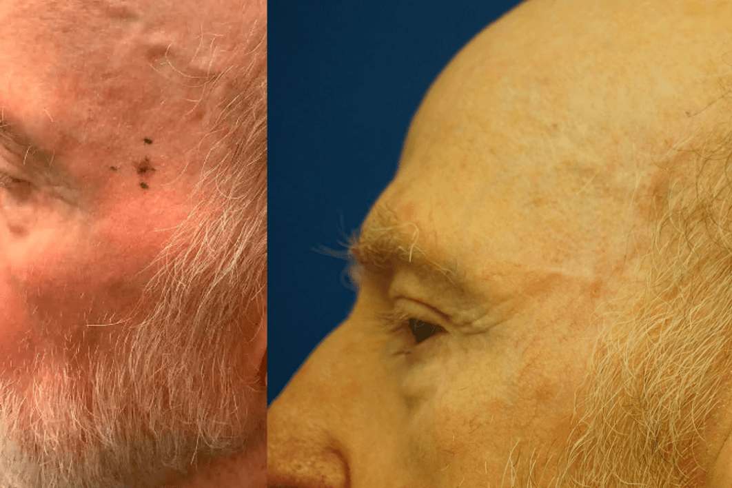 Skin Cancer Reconstruction - Before & After